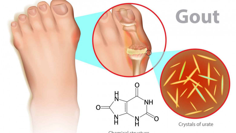 The Link Between Diet, Purines, and Elevated Uric Acid Levels