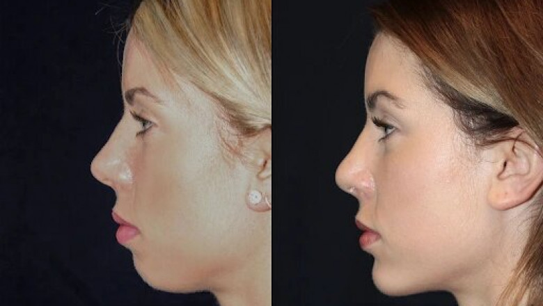 Best Aesthetic Clinics in dubai for Chin Fillers: Safe and Affordable