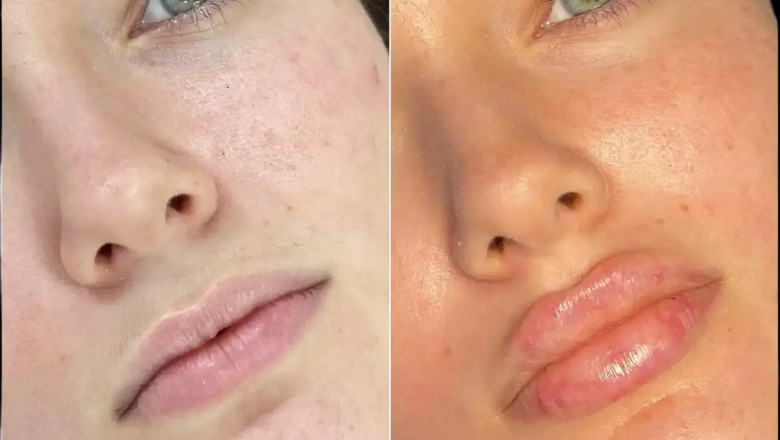 Best Aesthetic Clinics in Dubai for Fillers Recommended by Experts