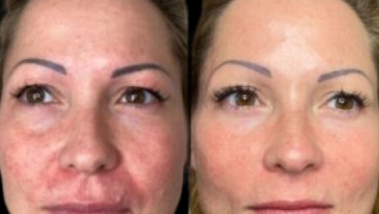 Best Aesthetic Clinics in Dubai for Profhilo: Everything You Need to Know Before Your Appointment
