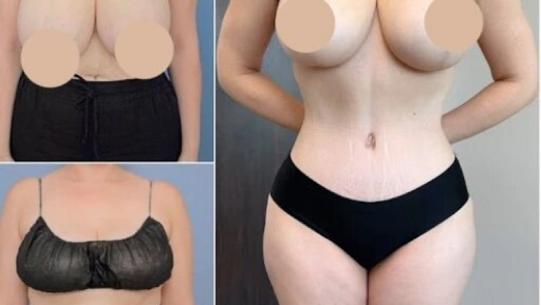 Is Body Contouring in Dubai Worth the Investment? Find Out!