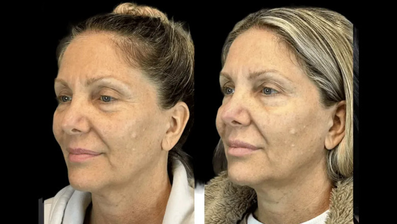 The Latest Botox Innovations Being Used by the Best Aesthetic Clinics in dubai