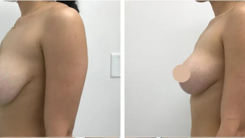 How a Breast Lift in Dubai Can Address Sagging and Nipple Position
