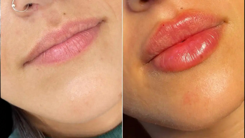 How Russian Lip Fillers in Dubai Enhance Your Natural Beauty