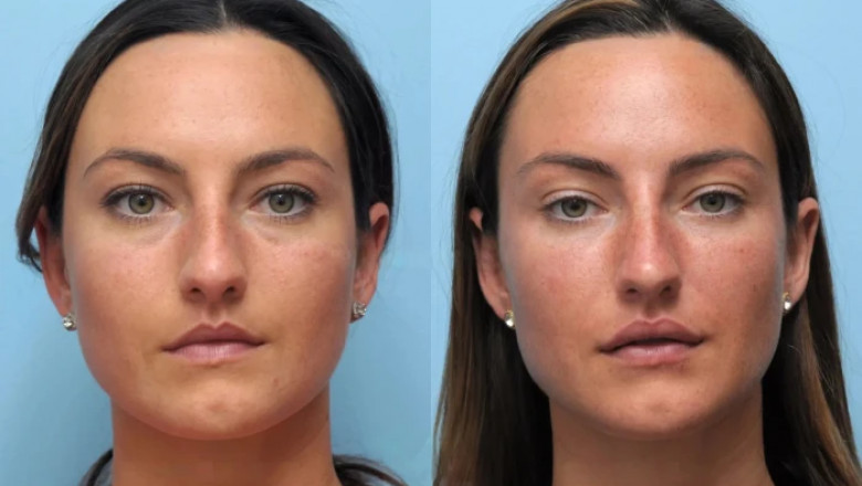 How Thread Lift in Dubai is Changing the Face of Beauty