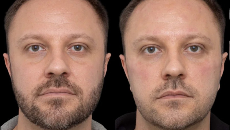 Top Clinics Offering Under Eye Fillers in Dubai