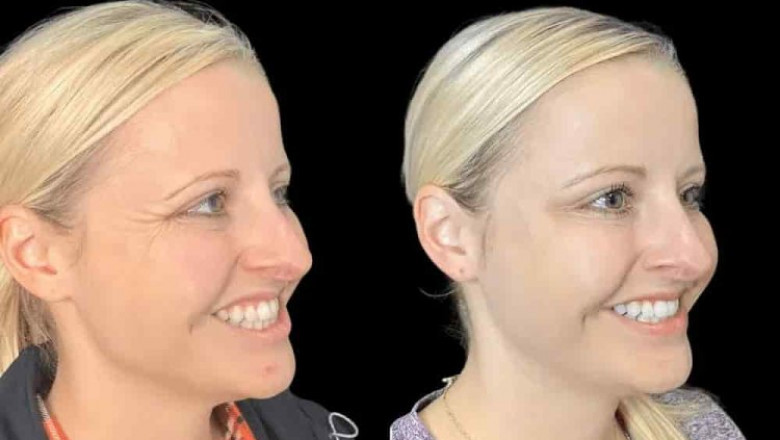 Why Botox in Dubai is a Popular Choice for Smooth Skin