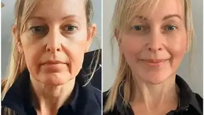 Redesign Youth with Profhilo by the Best Plastic Surgeons in dubai