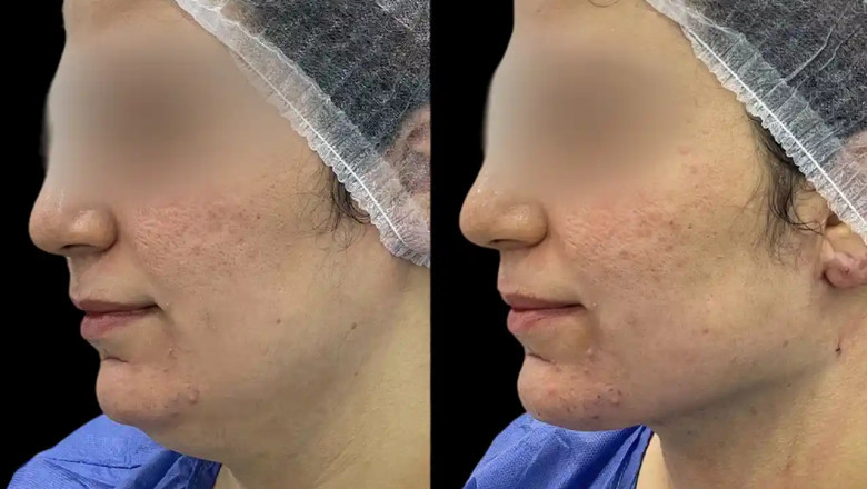 Best Plastic Surgeon in dubai for Chin Fillers: Enhance Your Facial Harmony