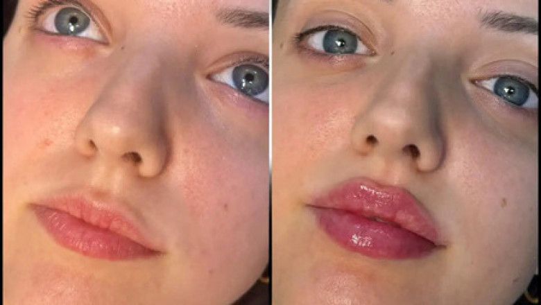 How Long Do Fillers Treatments in Dubai Last? Understanding the Longevity