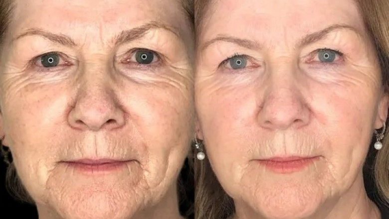 Recharge Skin Texture with Profhilo at Best Aesthetic Clinic in dubai