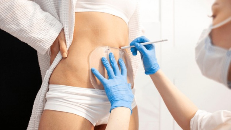 How Soon Before a Wedding or Vacation Should You Schedule CoolSculpting?