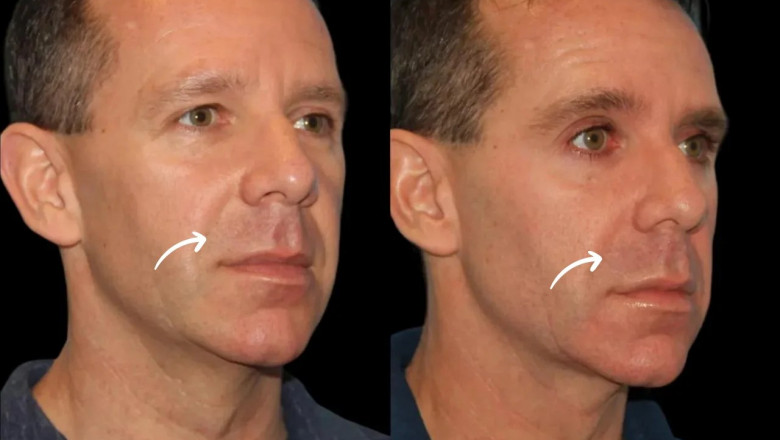 Natural Aging Solutions: Sculptra Fillers from Dubai’s Best Aesthetic Clinics