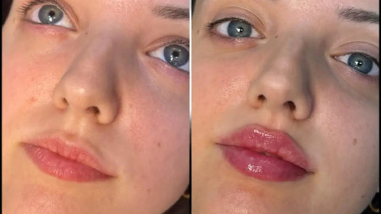 How to Choose the Best Plastic Surgeons in dubai for Fillers