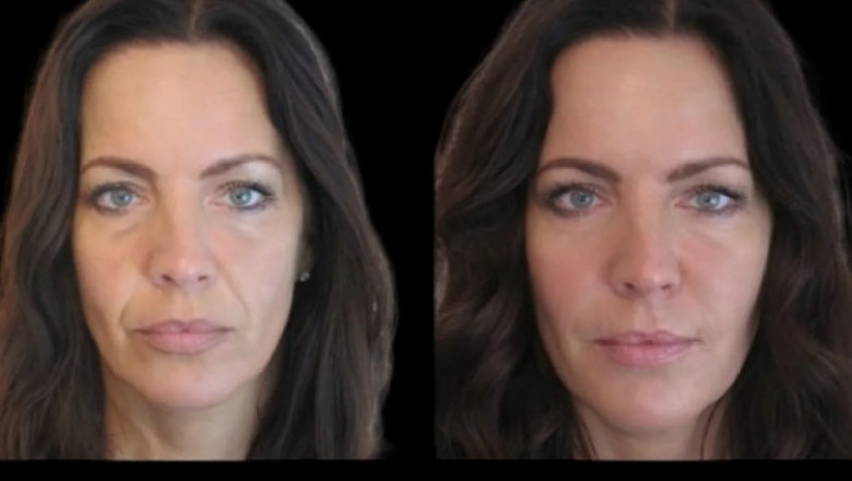 The Best Plastic Surgeons in dubai for Jawline Fillers: What Sets Them Apart?