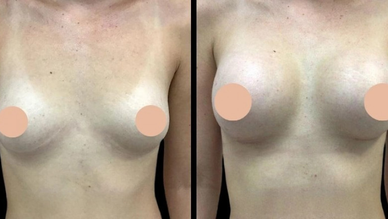 Long-Term Care After Breast Augmentation in Dubai