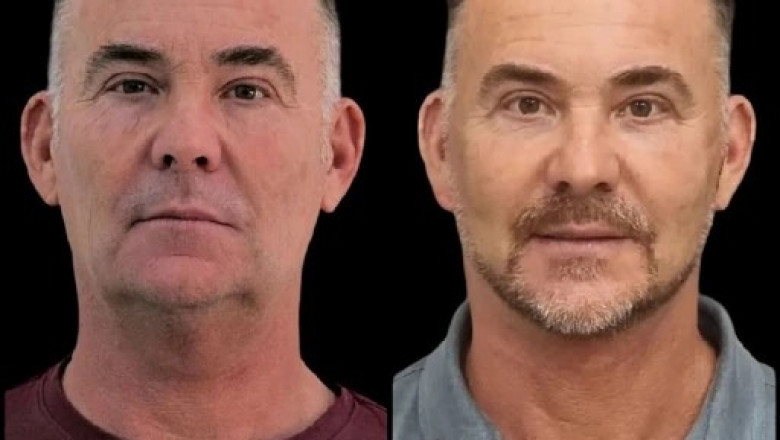 Charge Your Look with Profhilo Treatment in Dubai